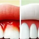 Home-Remedies-for-Gum-Pain-and-Swelling
