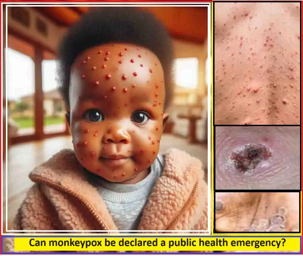 monkeypox